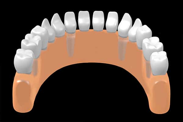 Four implants in clay model