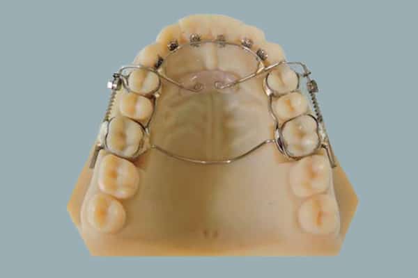 Self-Ligating Braces