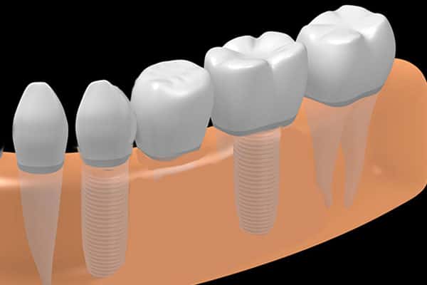 Implant supported bridge illustration