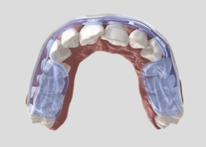 digital image of upper row of teeth